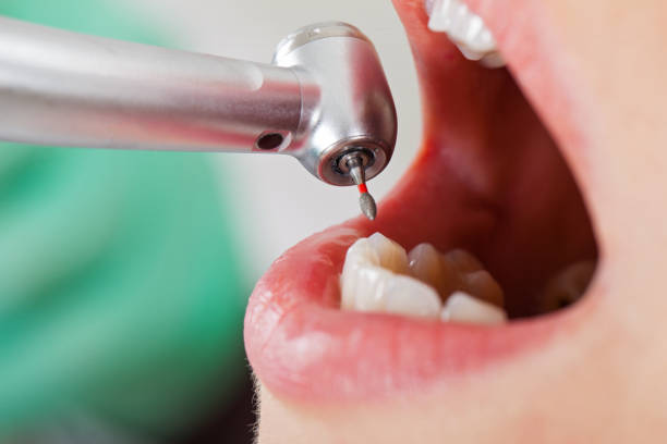 Best Urgent Care for Lost Fillings or Crowns in Temelec, CA